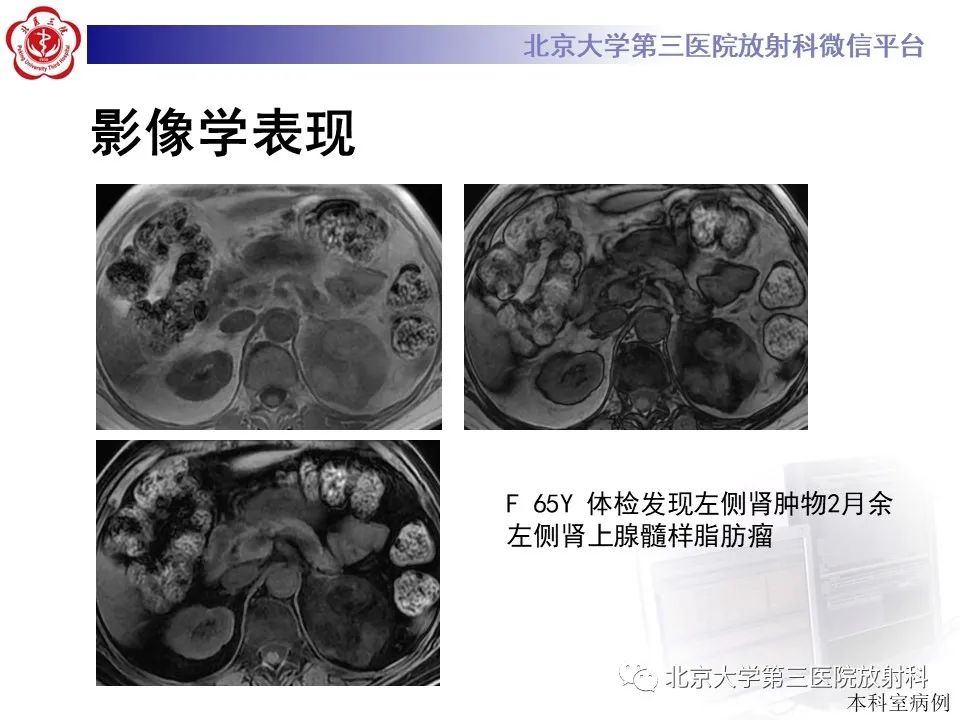 影像PPT - 【PPT】肾上腺髓样脂肪瘤-18