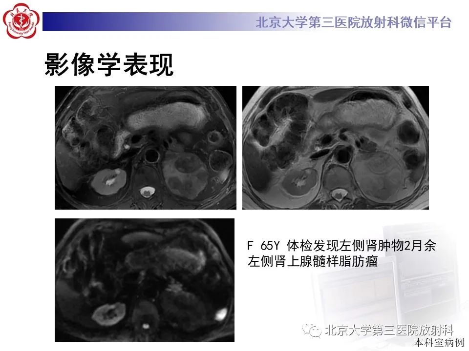 影像PPT - 【PPT】肾上腺髓样脂肪瘤-17