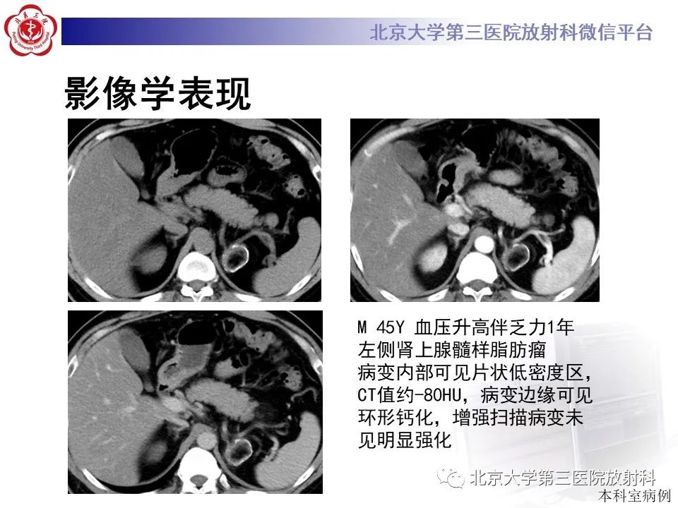 影像PPT - 【PPT】肾上腺髓样脂肪瘤-16