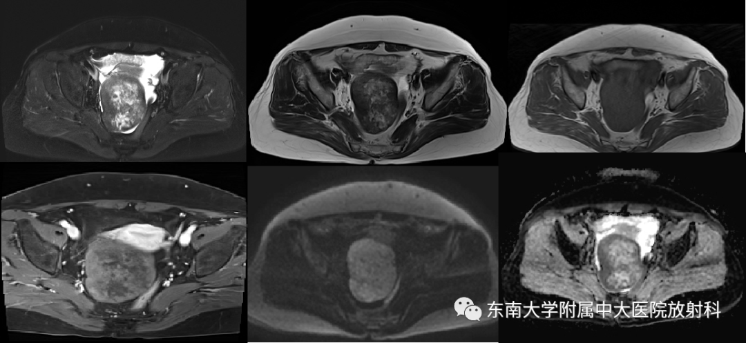 影像PPT - 【PPT】卵巢纤维卵泡膜细胞瘤-1