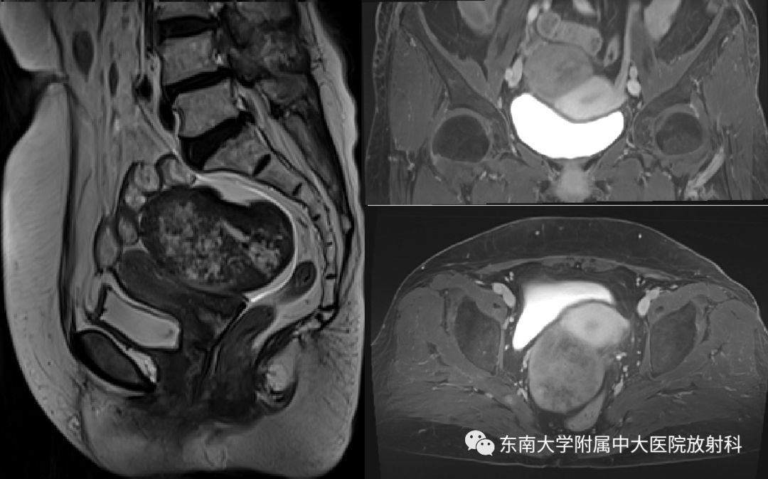 影像PPT - 【PPT】卵巢纤维卵泡膜细胞瘤-2