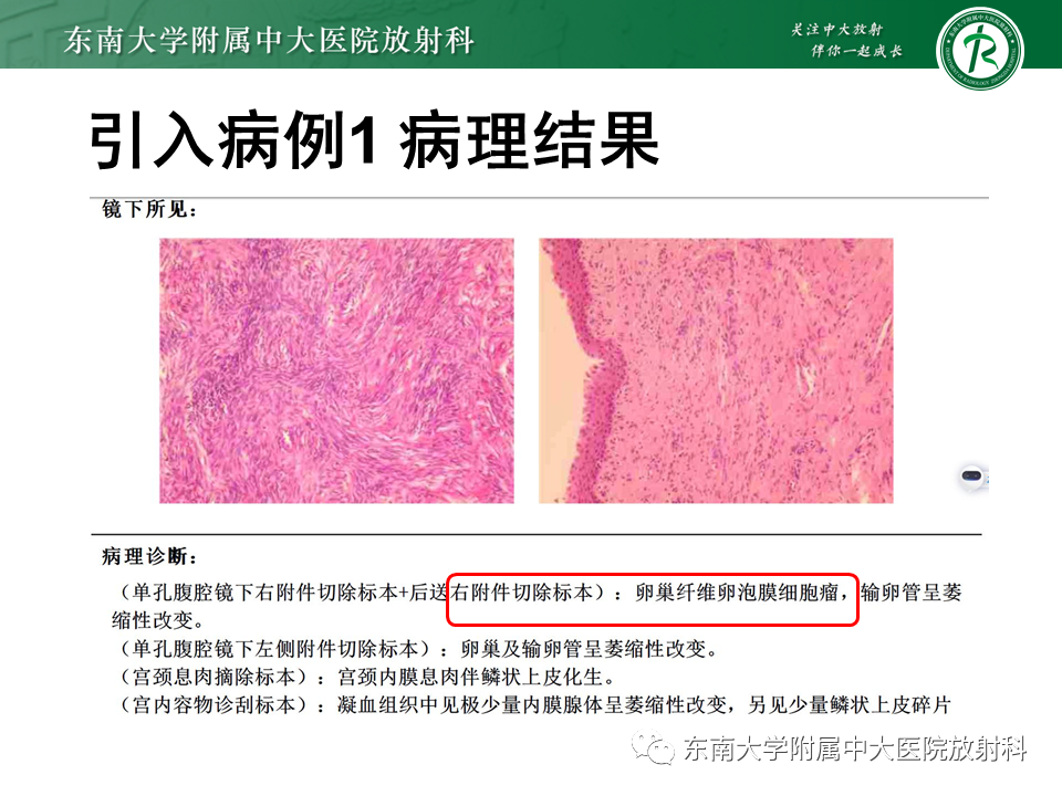 影像PPT - 【PPT】卵巢纤维卵泡膜细胞瘤-5
