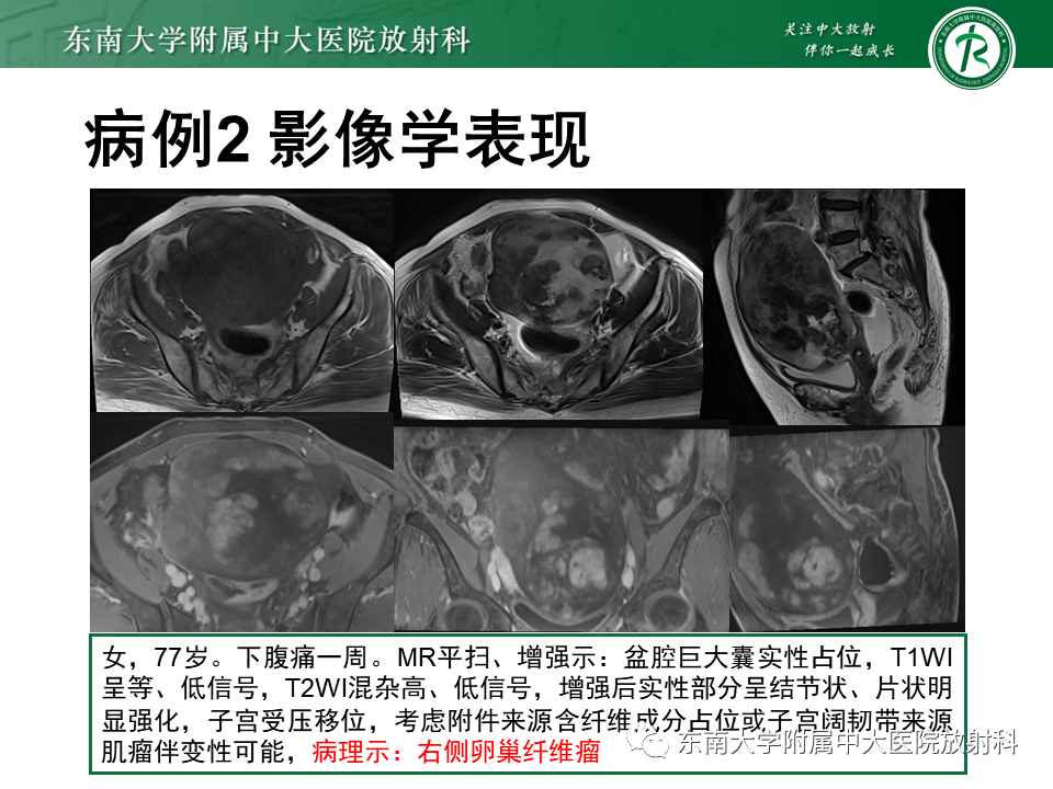 影像PPT - 【PPT】卵巢纤维卵泡膜细胞瘤-16
