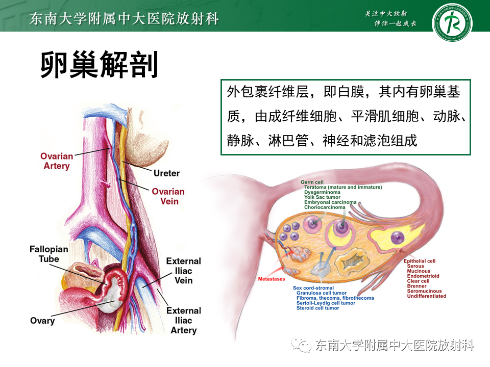 影像PPT - 【PPT】卵巢纤维卵泡膜细胞瘤-9
