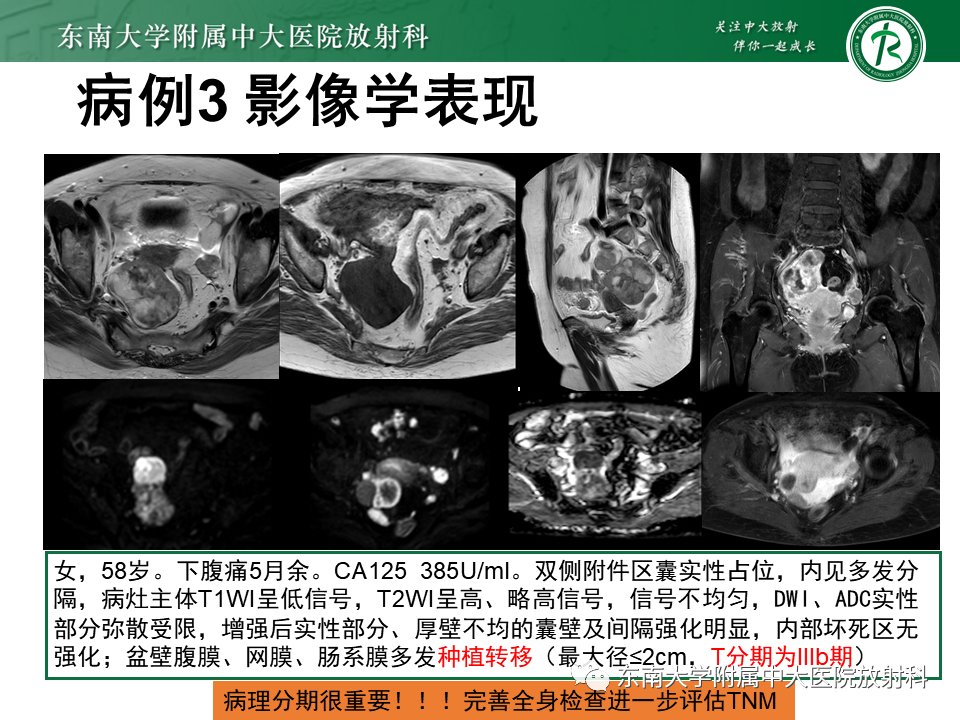 影像PPT - 【PPT】卵巢纤维卵泡膜细胞瘤-20