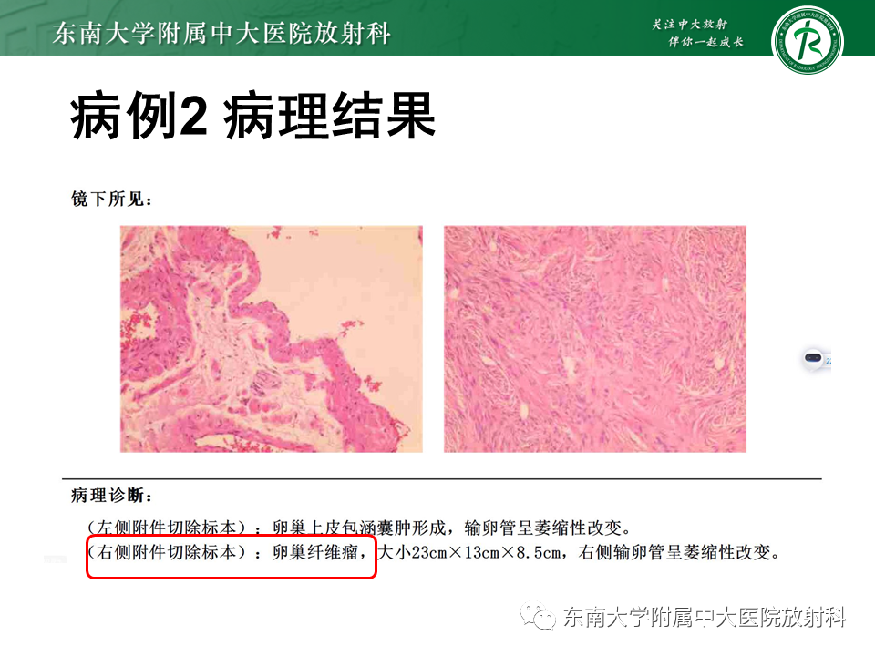 影像PPT - 【PPT】卵巢纤维卵泡膜细胞瘤-17
