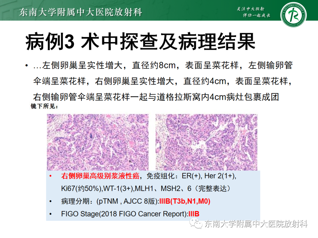 影像PPT - 【PPT】卵巢纤维卵泡膜细胞瘤-22