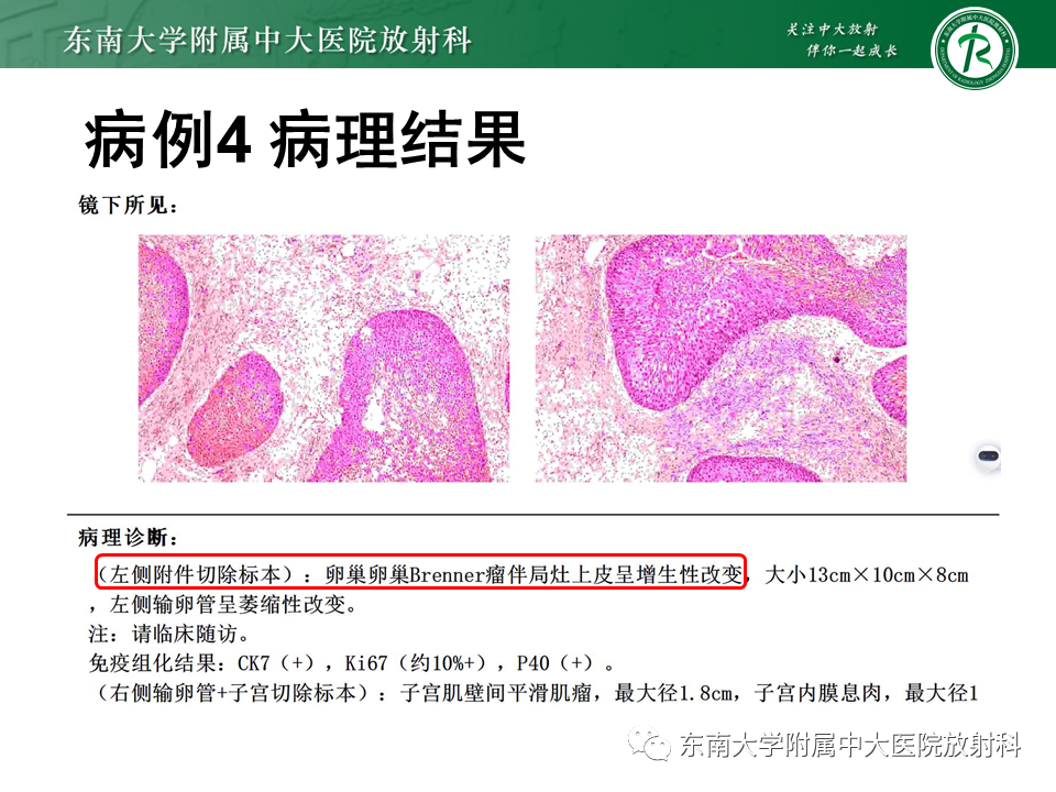 影像PPT - 【PPT】卵巢纤维卵泡膜细胞瘤-27