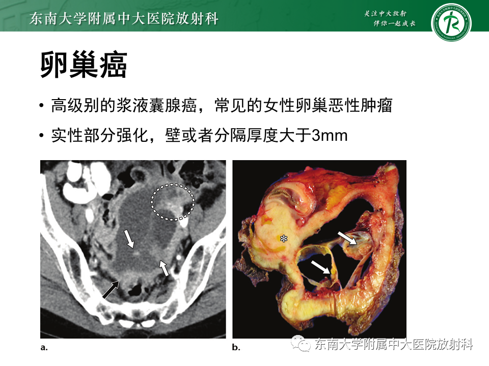 影像PPT - 【PPT】卵巢纤维卵泡膜细胞瘤-18