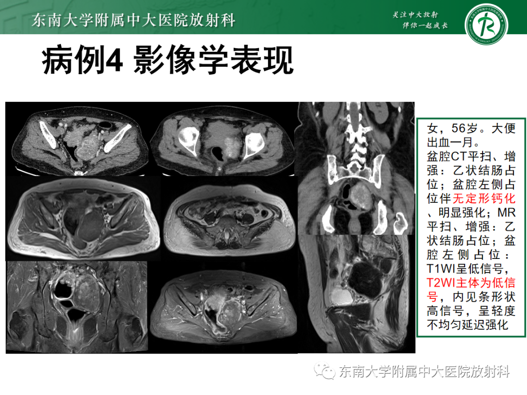影像PPT - 【PPT】卵巢纤维卵泡膜细胞瘤-26
