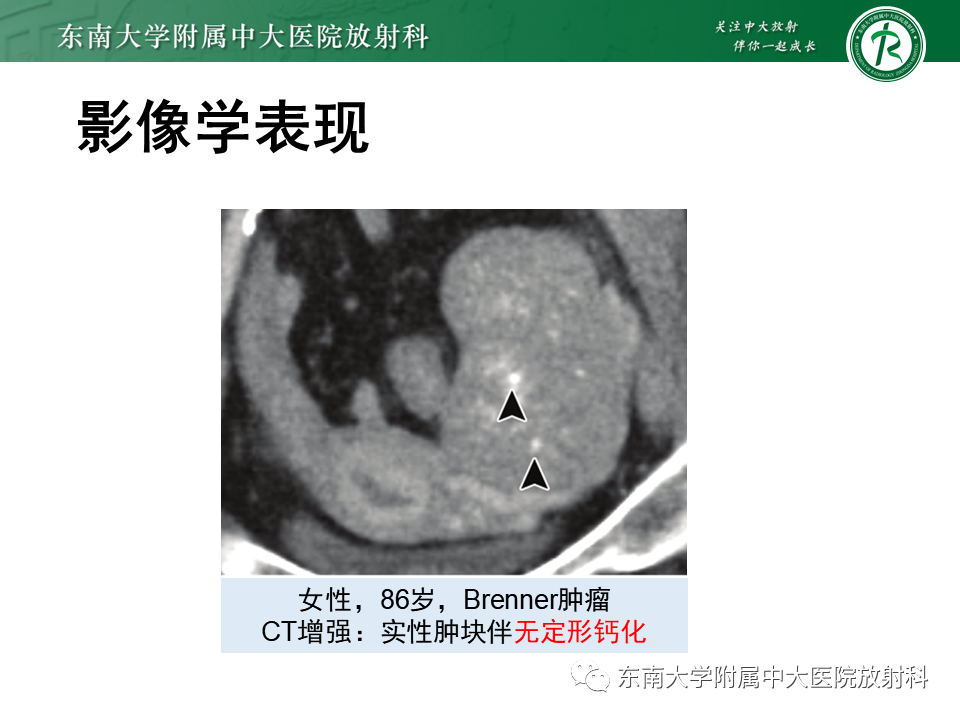 影像PPT - 【PPT】卵巢纤维卵泡膜细胞瘤-25