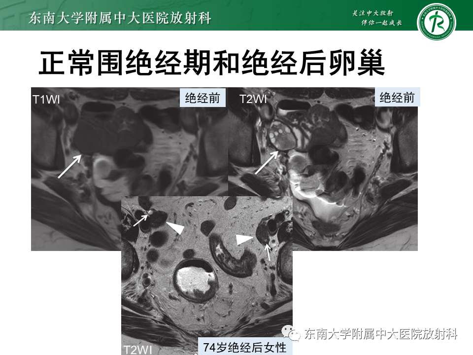影像PPT - 【PPT】卵巢纤维卵泡膜细胞瘤-11