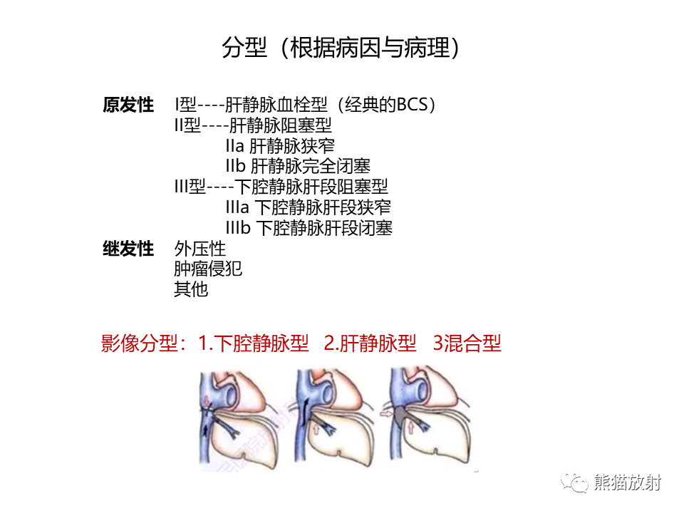 影像PPT - 【病例】布加综合征（肝静脉下腔静脉阻塞综合征）2例CT影像-26
