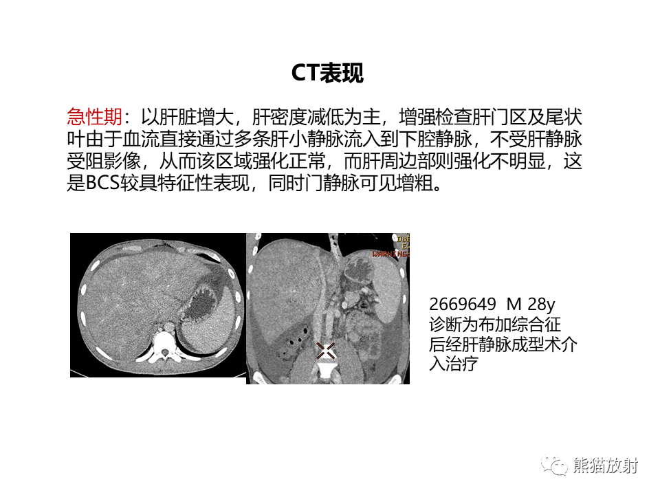 影像PPT - 【病例】布加综合征（肝静脉下腔静脉阻塞综合征）2例CT影像-29