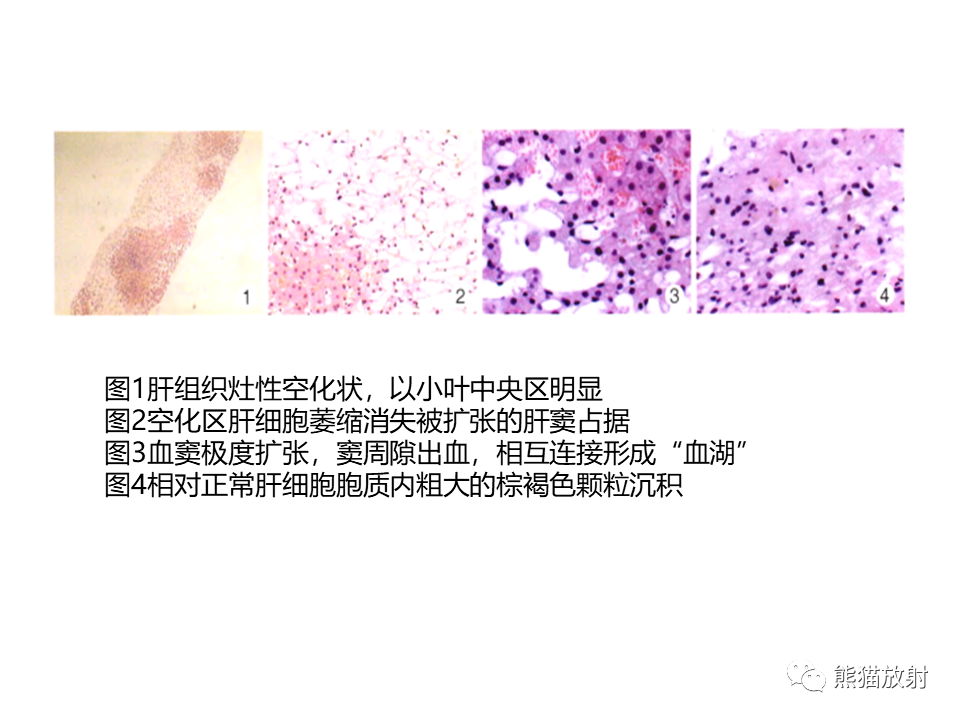 影像PPT - 【病例】布加综合征（肝静脉下腔静脉阻塞综合征）2例CT影像-25