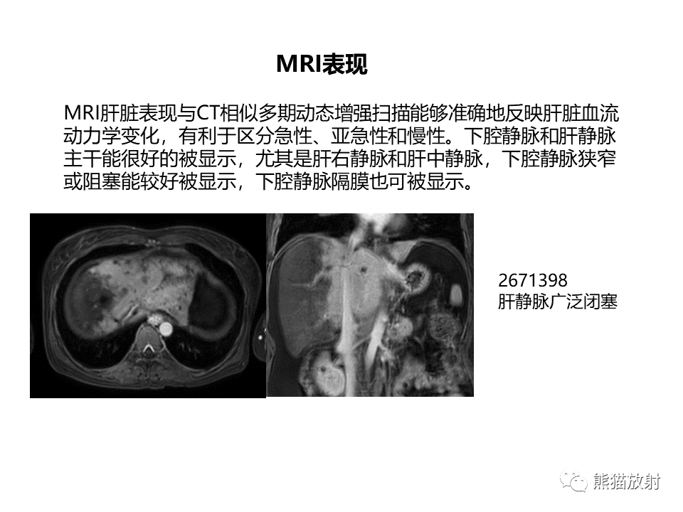 影像PPT - 【病例】布加综合征（肝静脉下腔静脉阻塞综合征）2例CT影像-34