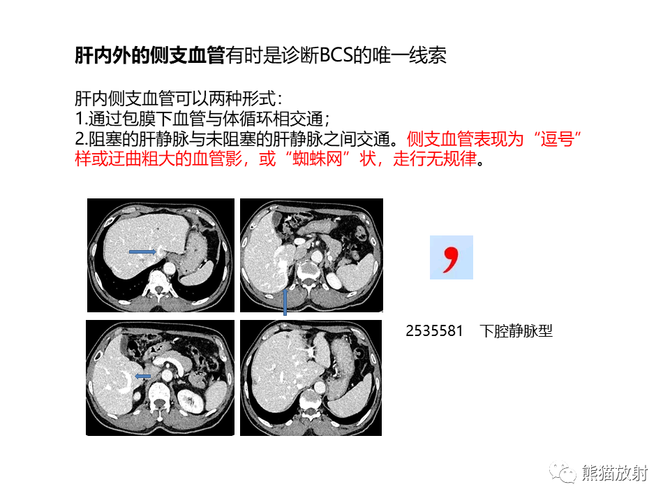 影像PPT - 【病例】布加综合征（肝静脉下腔静脉阻塞综合征）2例CT影像-32