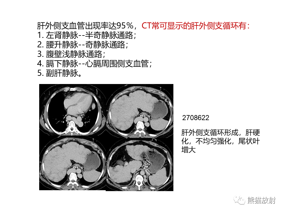 影像PPT - 【病例】布加综合征（肝静脉下腔静脉阻塞综合征）2例CT影像-33