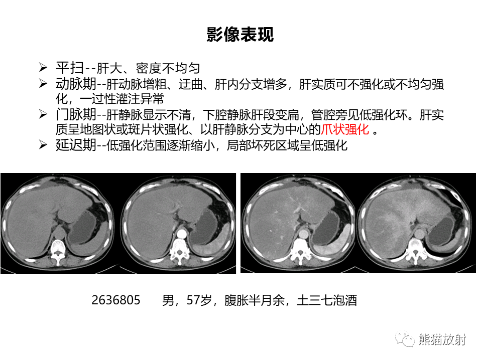 影像PPT - 【病例】布加综合征（肝静脉下腔静脉阻塞综合征）2例CT影像-36