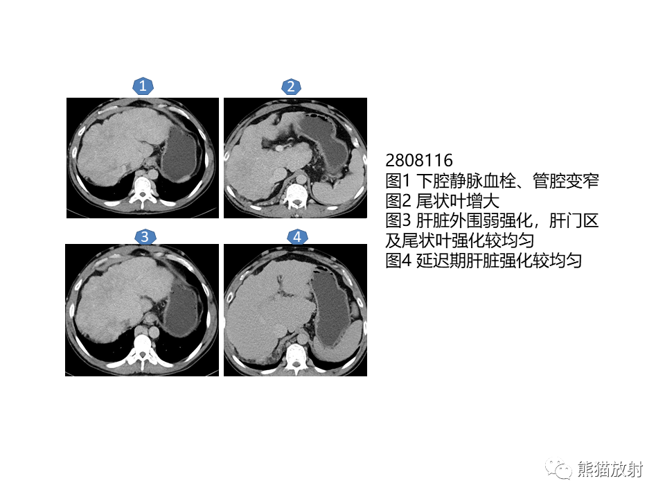 影像PPT - 【病例】布加综合征（肝静脉下腔静脉阻塞综合征）2例CT影像-31