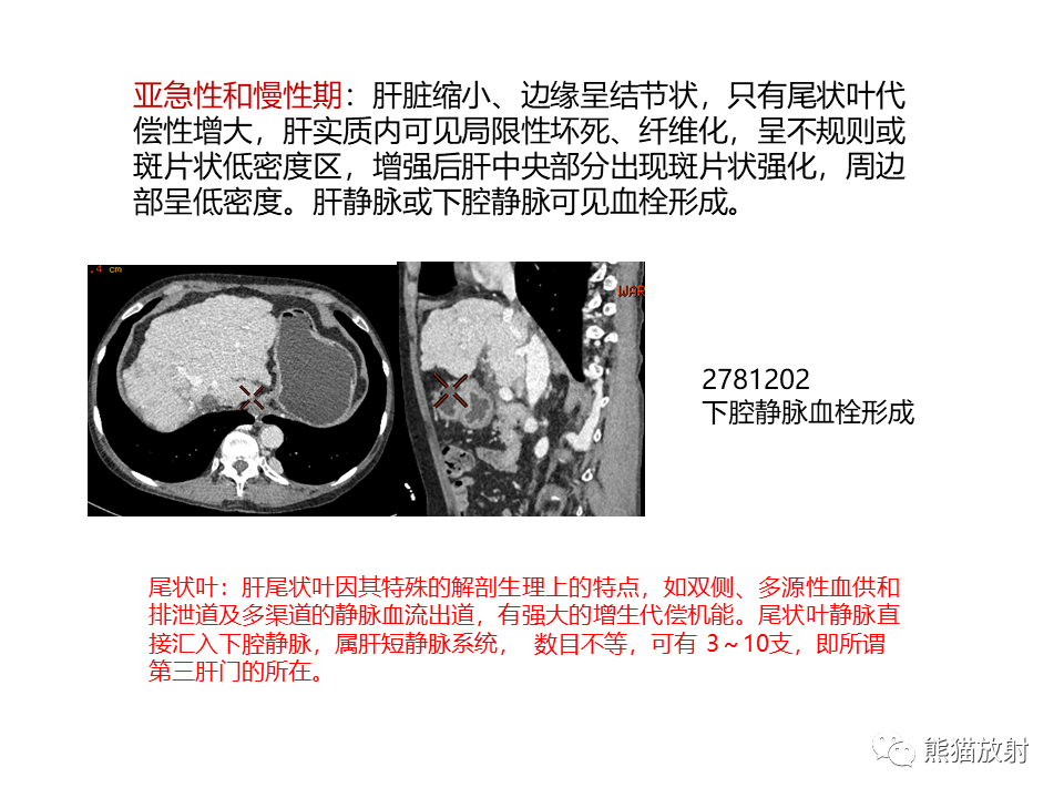 影像PPT - 【病例】布加综合征（肝静脉下腔静脉阻塞综合征）2例CT影像-30