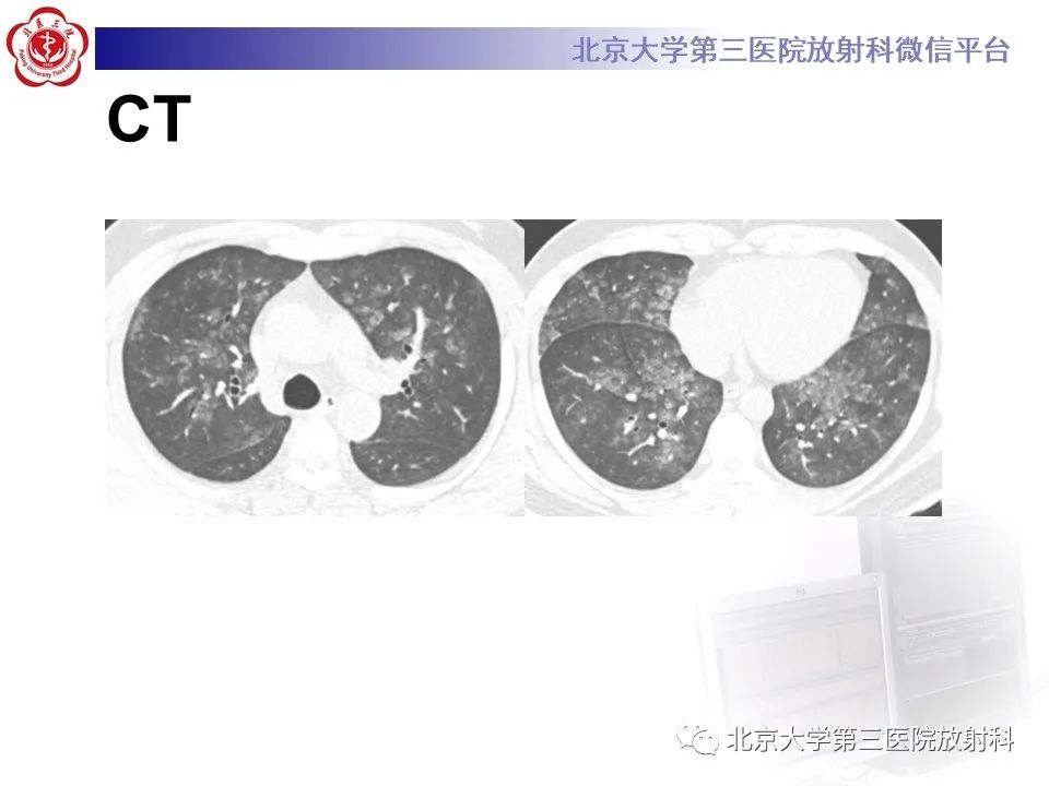 影像PPT - 【PPT】弥漫性肺泡出血-3