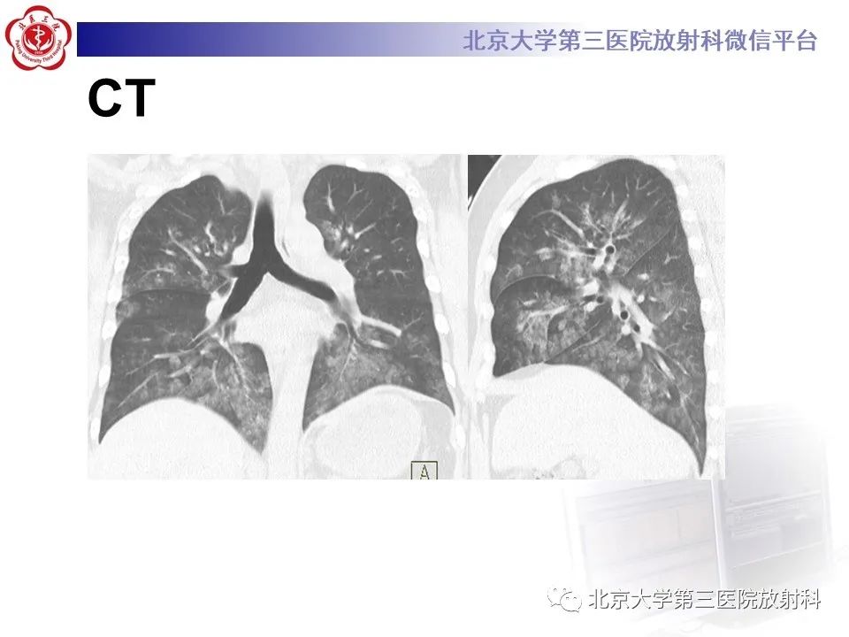 影像PPT - 【PPT】弥漫性肺泡出血-4