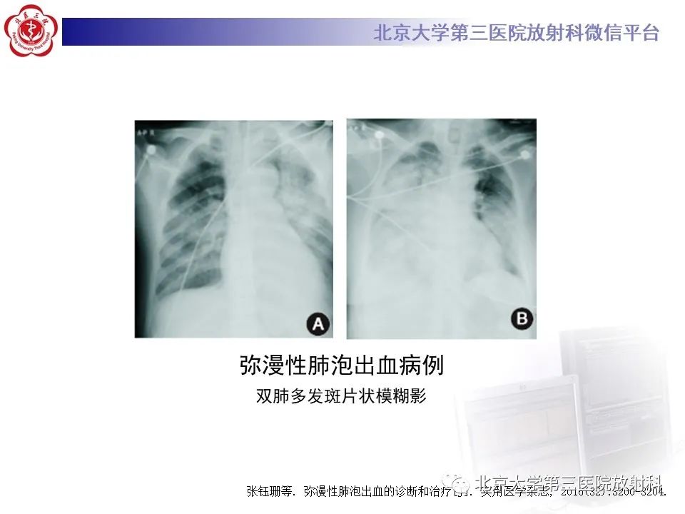 影像PPT - 【PPT】弥漫性肺泡出血-13