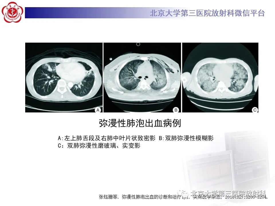 影像PPT - 【PPT】弥漫性肺泡出血-16