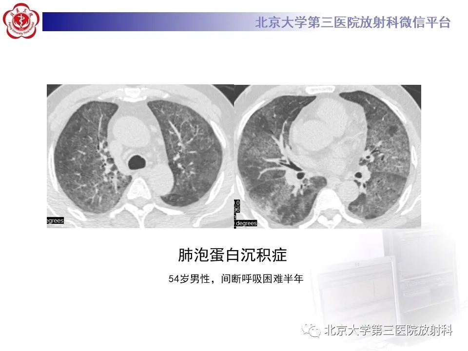 影像PPT - 【PPT】弥漫性肺泡出血-22