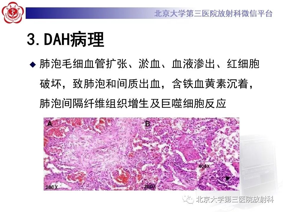 影像PPT - 【PPT】弥漫性肺泡出血-10