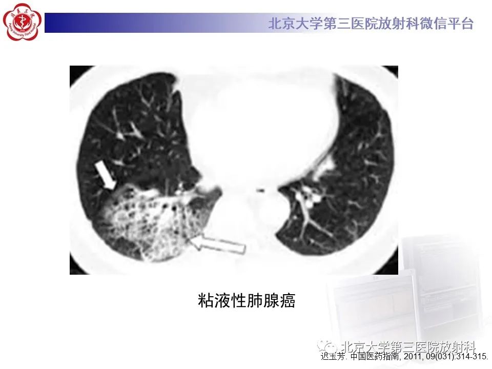 影像PPT - 【PPT】弥漫性肺泡出血-26