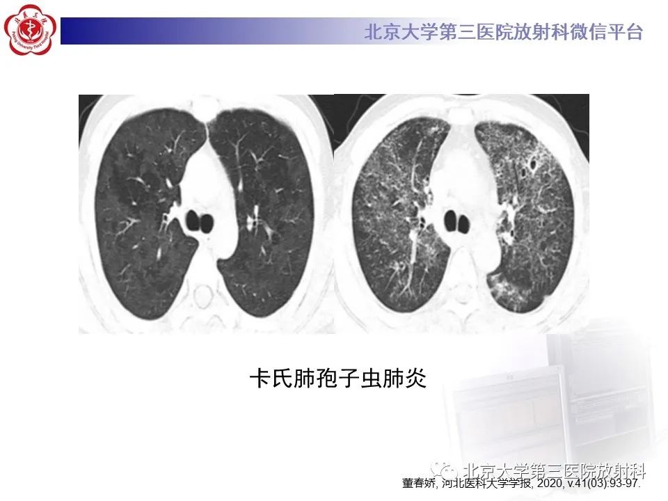 影像PPT - 【PPT】弥漫性肺泡出血-24