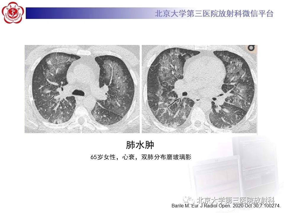 影像PPT - 【PPT】弥漫性肺泡出血-20