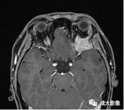 影像PPT - 【PPT】眼眶朗格汉斯细胞组织细胞增生症影像学表现-2 影像PPT - 【PPT】眼眶朗格汉斯细胞组织细胞增生症影像学表现-2
