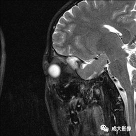 影像PPT - 【PPT】眼眶朗格汉斯细胞组织细胞增生症影像学表现-4 影像PPT - 【PPT】眼眶朗格汉斯细胞组织细胞增生症影像学表现-4