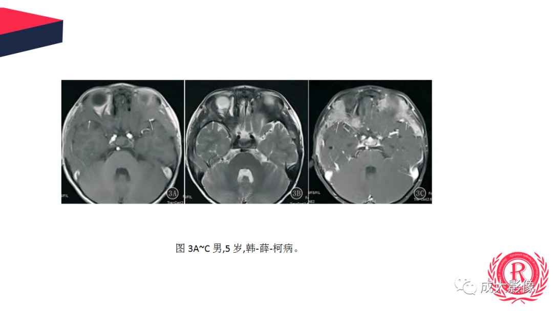 影像PPT - 【PPT】眼眶朗格汉斯细胞组织细胞增生症影像学表现-19 影像PPT - 【PPT】眼眶朗格汉斯细胞组织细胞增生症影像学表现-19