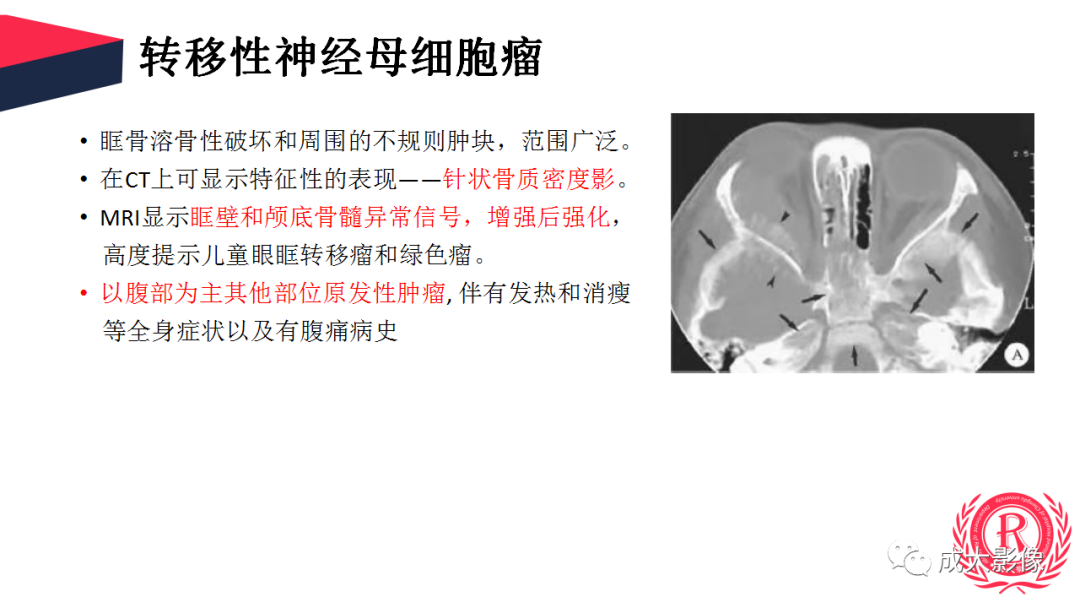 影像PPT - 【PPT】眼眶朗格汉斯细胞组织细胞增生症影像学表现-21 影像PPT - 【PPT】眼眶朗格汉斯细胞组织细胞增生症影像学表现-21