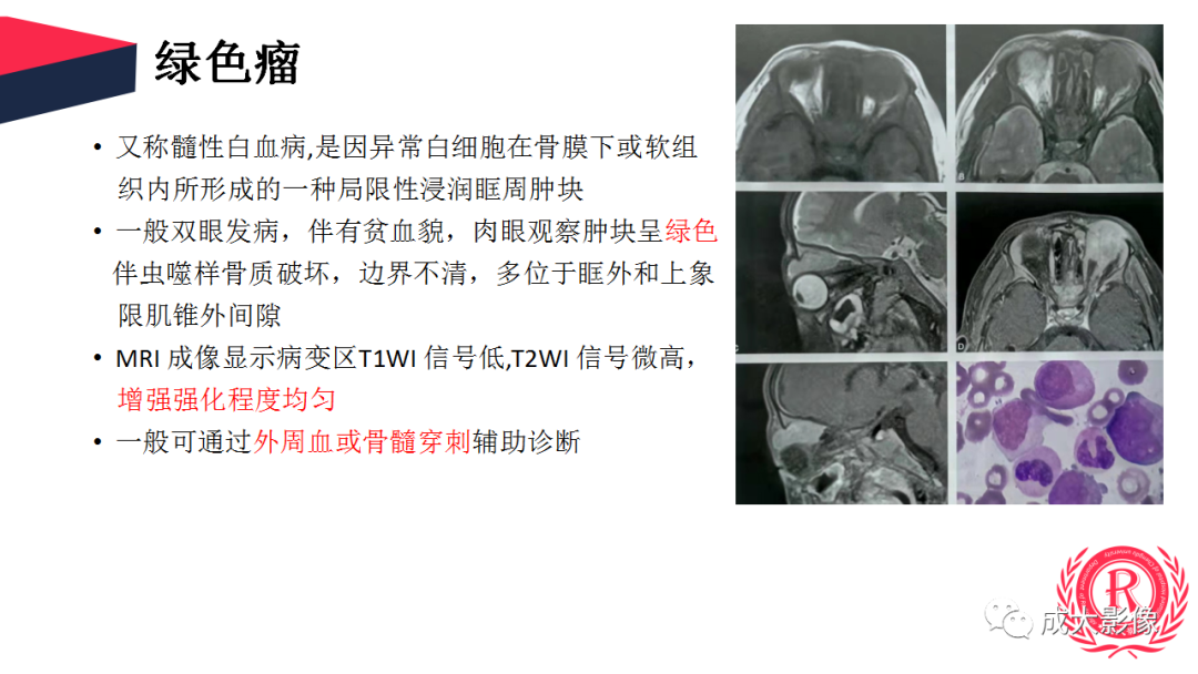 影像PPT - 【PPT】眼眶朗格汉斯细胞组织细胞增生症影像学表现-22 影像PPT - 【PPT】眼眶朗格汉斯细胞组织细胞增生症影像学表现-22