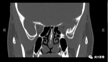 影像PPT - 【PPT】眼眶朗格汉斯细胞组织细胞增生症影像学表现-7 影像PPT - 【PPT】眼眶朗格汉斯细胞组织细胞增生症影像学表现-7