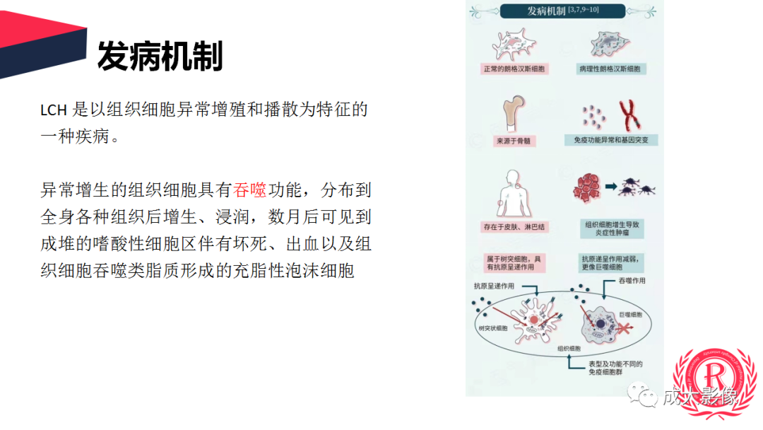 影像PPT - 【PPT】眼眶朗格汉斯细胞组织细胞增生症影像学表现-11 影像PPT - 【PPT】眼眶朗格汉斯细胞组织细胞增生症影像学表现-11