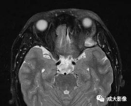 影像PPT - 【PPT】眼眶朗格汉斯细胞组织细胞增生症影像学表现-3 影像PPT - 【PPT】眼眶朗格汉斯细胞组织细胞增生症影像学表现-3