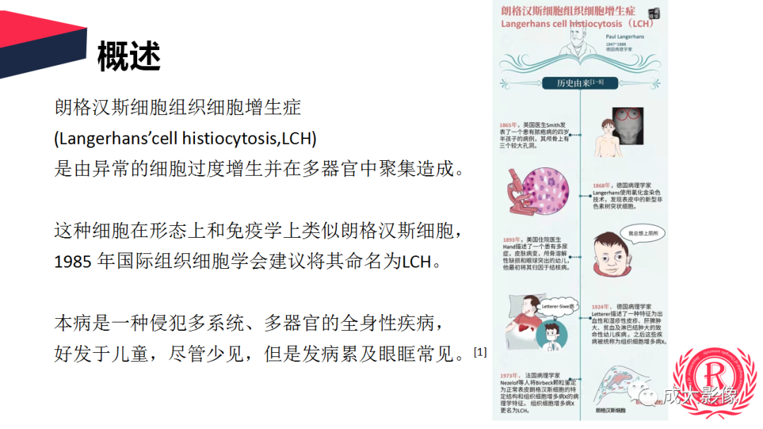 影像PPT - 【PPT】眼眶朗格汉斯细胞组织细胞增生症影像学表现-10 影像PPT - 【PPT】眼眶朗格汉斯细胞组织细胞增生症影像学表现-10