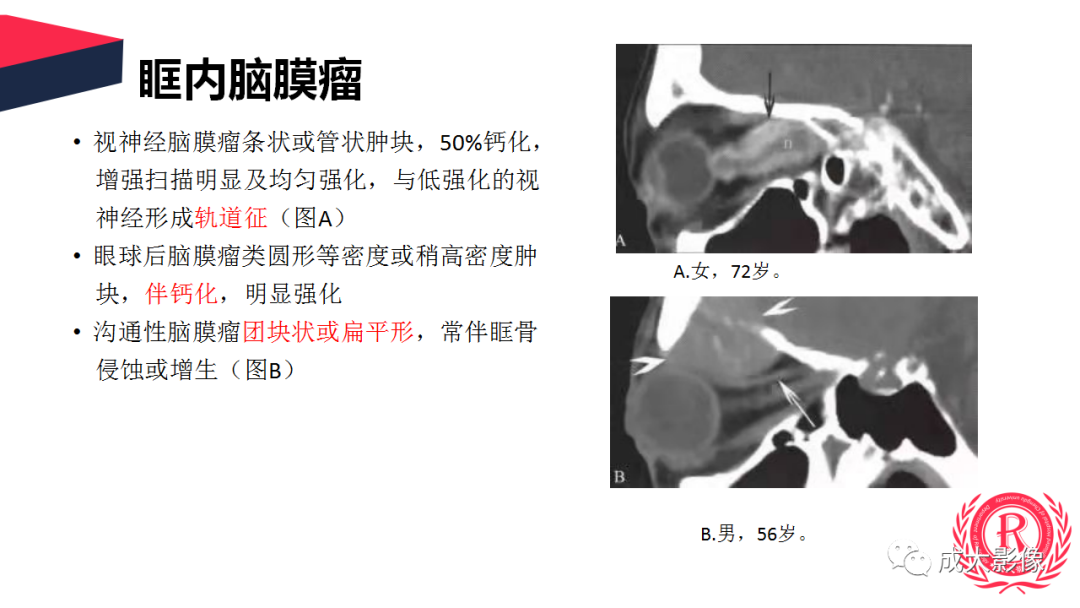 影像PPT - 【PPT】眼眶朗格汉斯细胞组织细胞增生症影像学表现-27 影像PPT - 【PPT】眼眶朗格汉斯细胞组织细胞增生症影像学表现-27