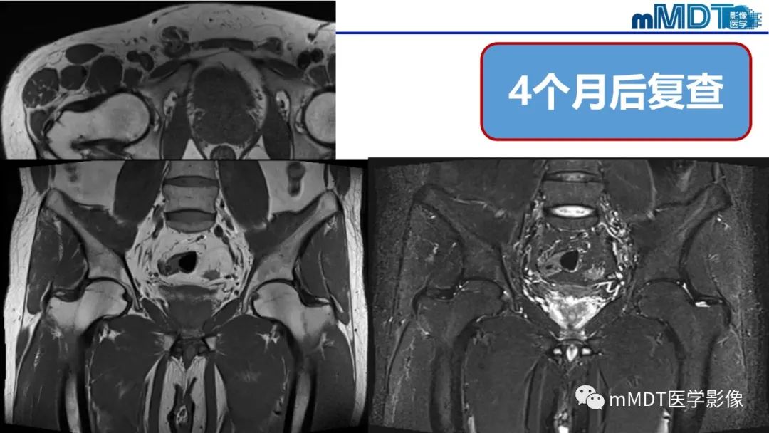 影像PPT - 【PPT】髋关节疼痛临床与影像(一)-6 影像PPT - 【PPT】髋关节疼痛临床与影像(一)-6