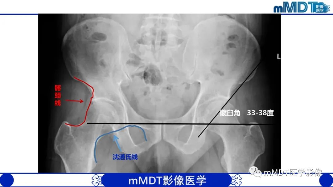 影像PPT - 【PPT】髋关节疼痛临床与影像(一)-7 影像PPT - 【PPT】髋关节疼痛临床与影像(一)-7