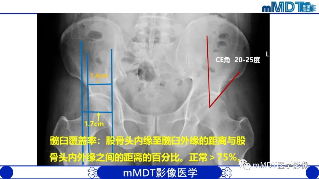 影像PPT - 【PPT】髋关节疼痛临床与影像(一)-8 影像PPT - 【PPT】髋关节疼痛临床与影像(一)-8
