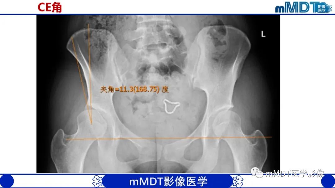 影像PPT - 【PPT】髋关节疼痛临床与影像(一)-9 影像PPT - 【PPT】髋关节疼痛临床与影像(一)-9