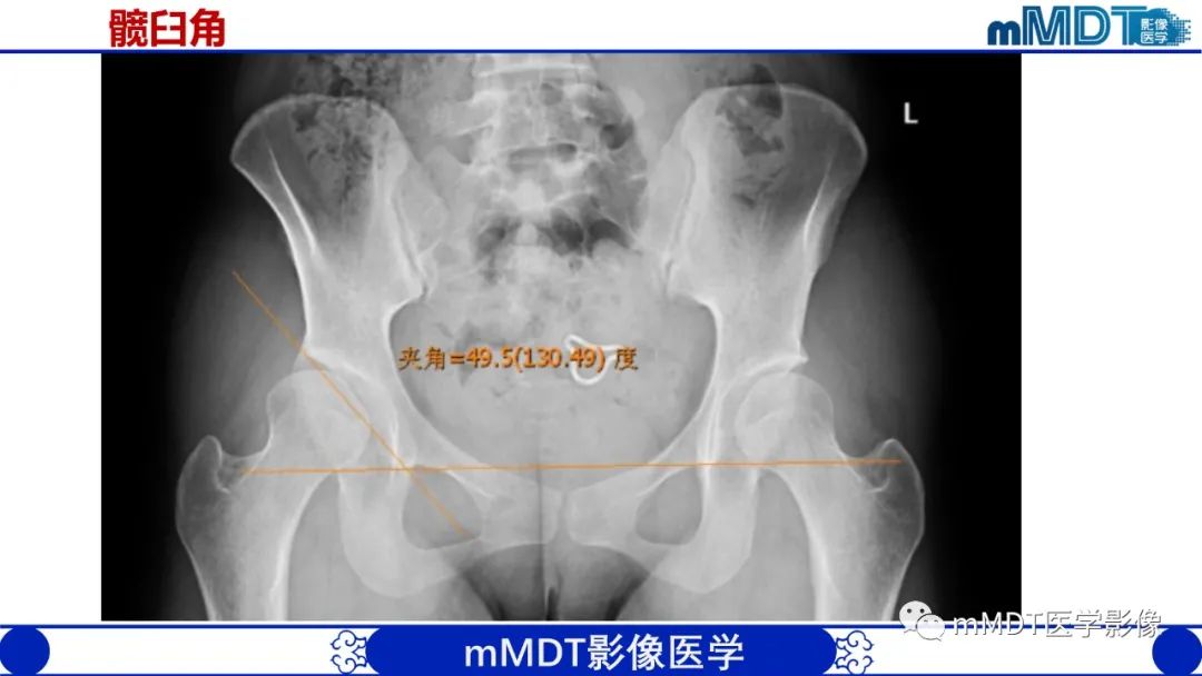 影像PPT - 【PPT】髋关节疼痛临床与影像(一)-10 影像PPT - 【PPT】髋关节疼痛临床与影像(一)-10