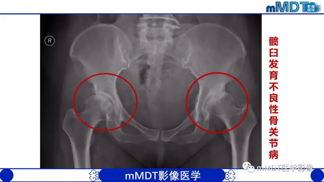 影像PPT - 【PPT】髋关节疼痛临床与影像(一)-12 影像PPT - 【PPT】髋关节疼痛临床与影像(一)-12
